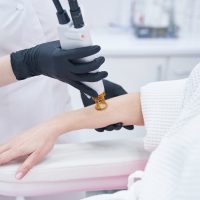 Close up of female doctor hands in sterile gloves removing hair from woman arm with alexandrite laser machine